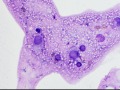 Chondroid-producing sarcoma