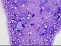 Chondroid-producing sarcoma