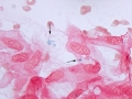Keloidal fibroma/fibrosarcoma (PB)
