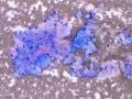 Soft tissue sarcoma