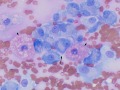 Soft tissue sarcoma