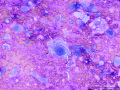 Chondrosarcoma