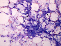 Suspect liposarcoma (dog)