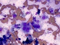 Melanoma