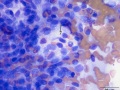 Recurrent soft tissue sarcoma