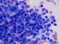 Recurrent soft tissue sarcoma