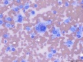 Recurrent soft tissue sarcoma