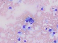 Recurrent soft tissue sarcoma