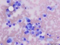 Recurrent soft tissue sarcoma
