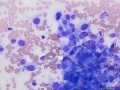 Recurrent soft tissue sarcoma