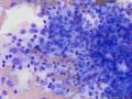 Recurrent soft tissue sarcoma