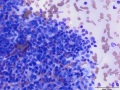 Recurrent soft tissue sarcoma