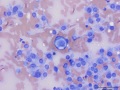 Recurrent soft tissue sarcoma