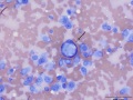 Recurrent soft tissue sarcoma