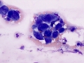 Suspect hemangiosarcoma (shoulder)