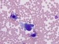 Suspect hemangiosarcoma (shoulder)