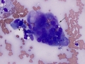 Sarcoma with giant cells (cat)