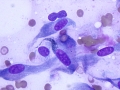 Keloidal fibroma/fibrosarcoma (DQ)