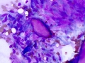 Keloidal fibroma/fibrosarcoma (DQ)