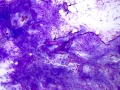 Keloidal fibroma/fibrosarcoma (DQ)