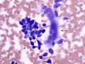 Osteosarcoma (humerus)