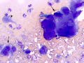 Carcinoma