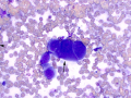 Carcinoma