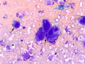 Carcinoma