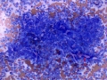 Osteosarcoma (radius)
