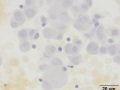 Urothelial carcinoma (lymph node, ALP stain)