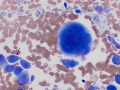 Urothelial carcinoma (lymph node)