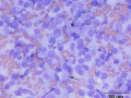 Melanoma