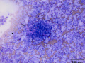 Melanoma