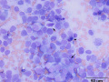 Melanoma