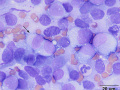 Melanoma