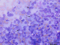 Melanoma