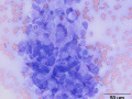 Melanoma