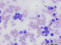 Myeloma