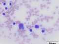 Myeloma