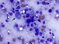 Osteosarcoma (femur)