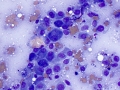 Osteosarcoma (femur)