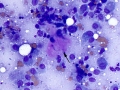Osteosarcoma (bone)