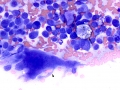 Osteosarcoma (osteoclast, radius)