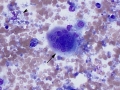 Osteosarcoma (lung)