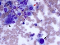 Osteosarcoma (lung)