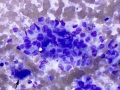 Osteosarcoma (lung)