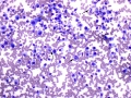 Osteosarcoma (mitoses, radius)
