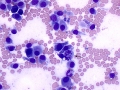 Osteosarcoma (radius)