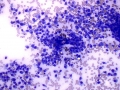Osteosarcoma (radius)