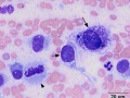 Chondrosarcoma